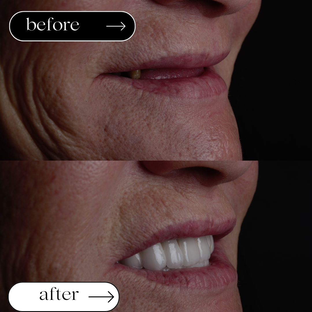 Fall 3: All-on-4 Versorgung